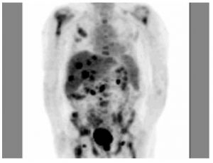 Application of PET/CT in Colorectal Cancer - PET/CT Imaging of Berkeley