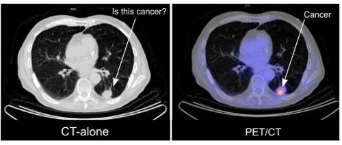 Application of PET/CT in Lung Cancer PET/CT Imaging Berkeley